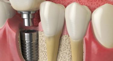 Ankylos dental implants